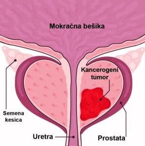 rak-prostate